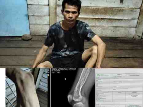 Pekerja PT Surya Dumai Agrindo Terlantar dan Lapar Usai Kecelakaan Kerja, Sabam: “Tolong Kami Pak Kadis”